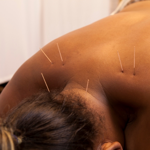 dry-needling-IMS-anatomy-physiotherapy-clinic-orleans-st-laurent-westboro-stittsville