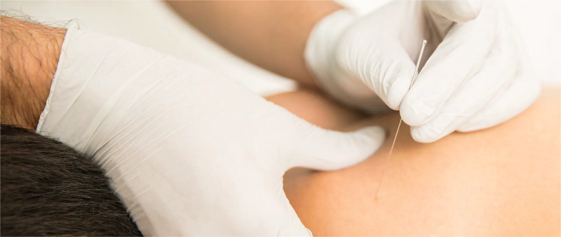 FUNCTIONAL DRY NEEDLING® LEVEL 2